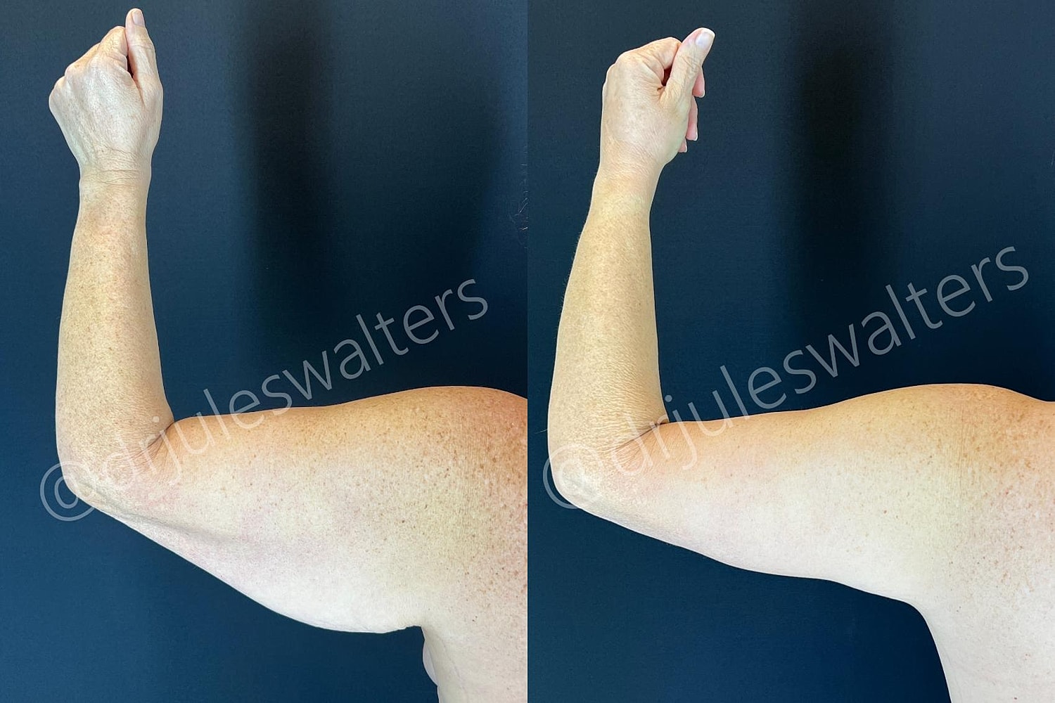 Arm Lift Brachioplasty Before & After