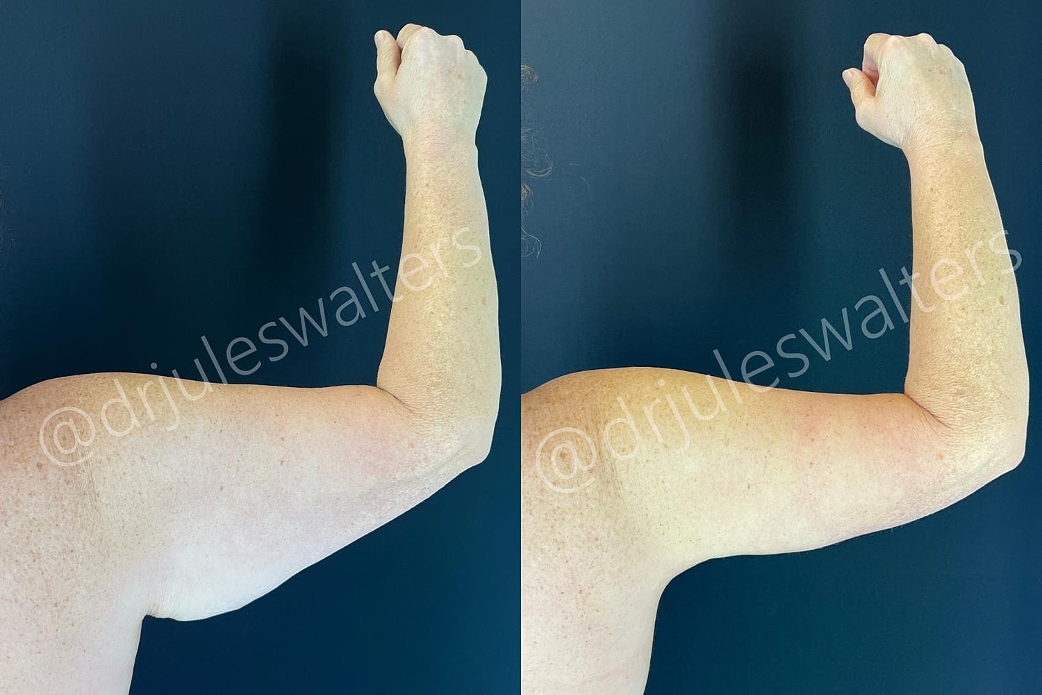 Arm Lift Brachioplasty Before & After
