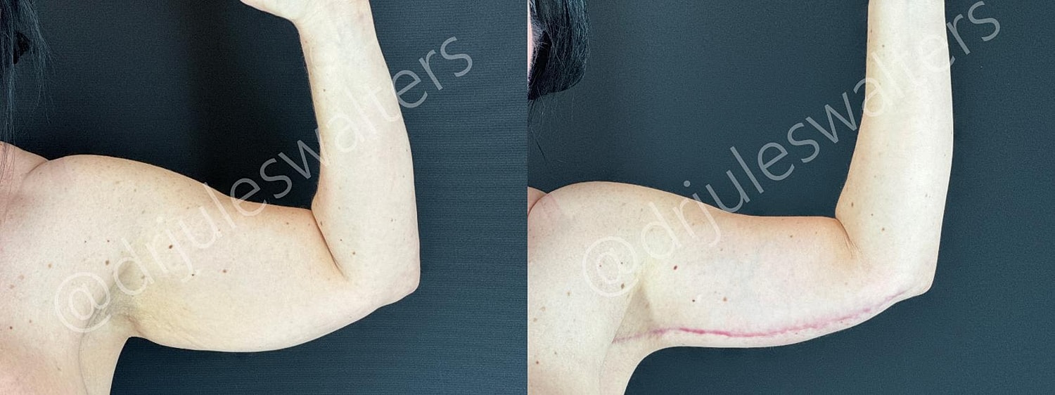Arm Lift Brachioplasty Before & After