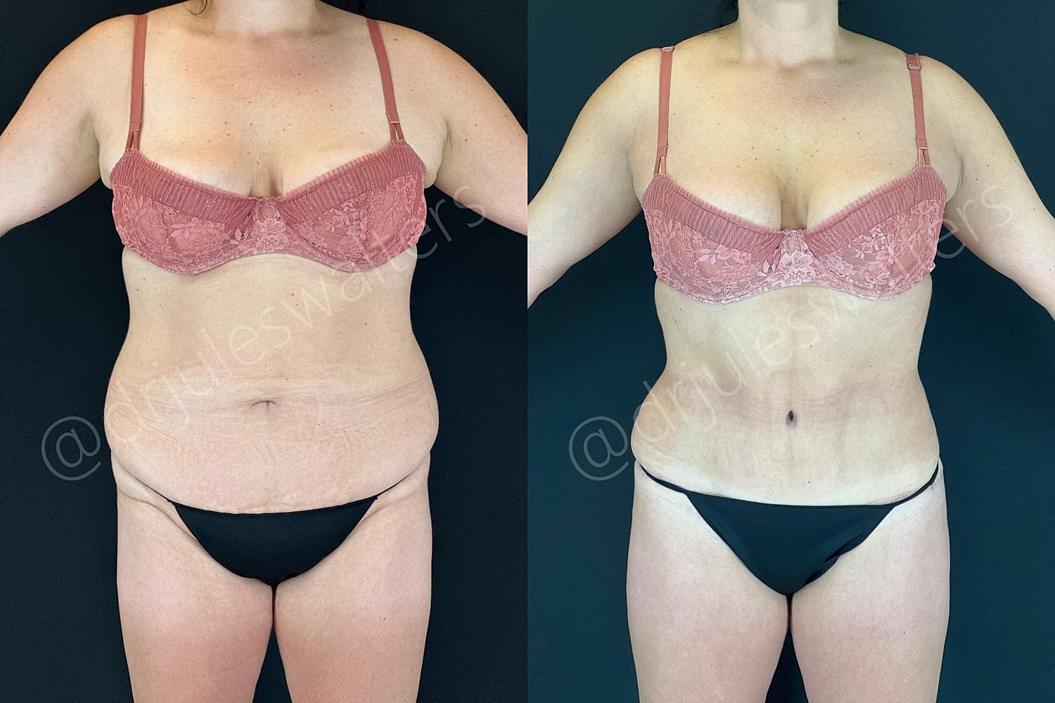 Tummy Tuck Before & After