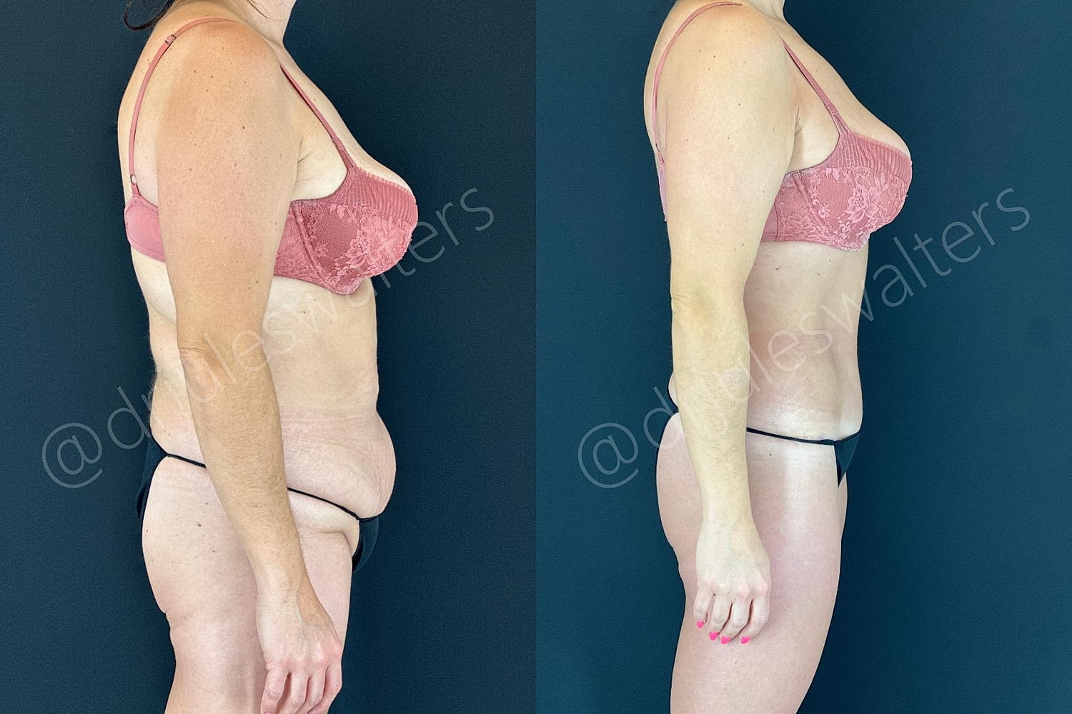 Tummy Tuck Before & After