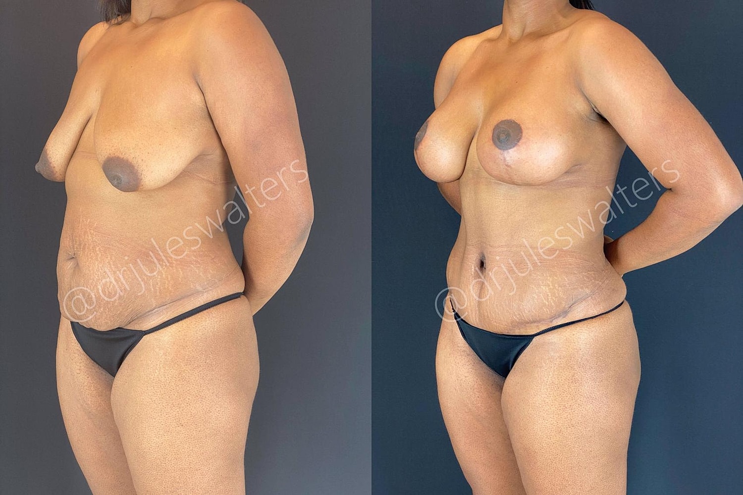 Tummy Tuck Before & After