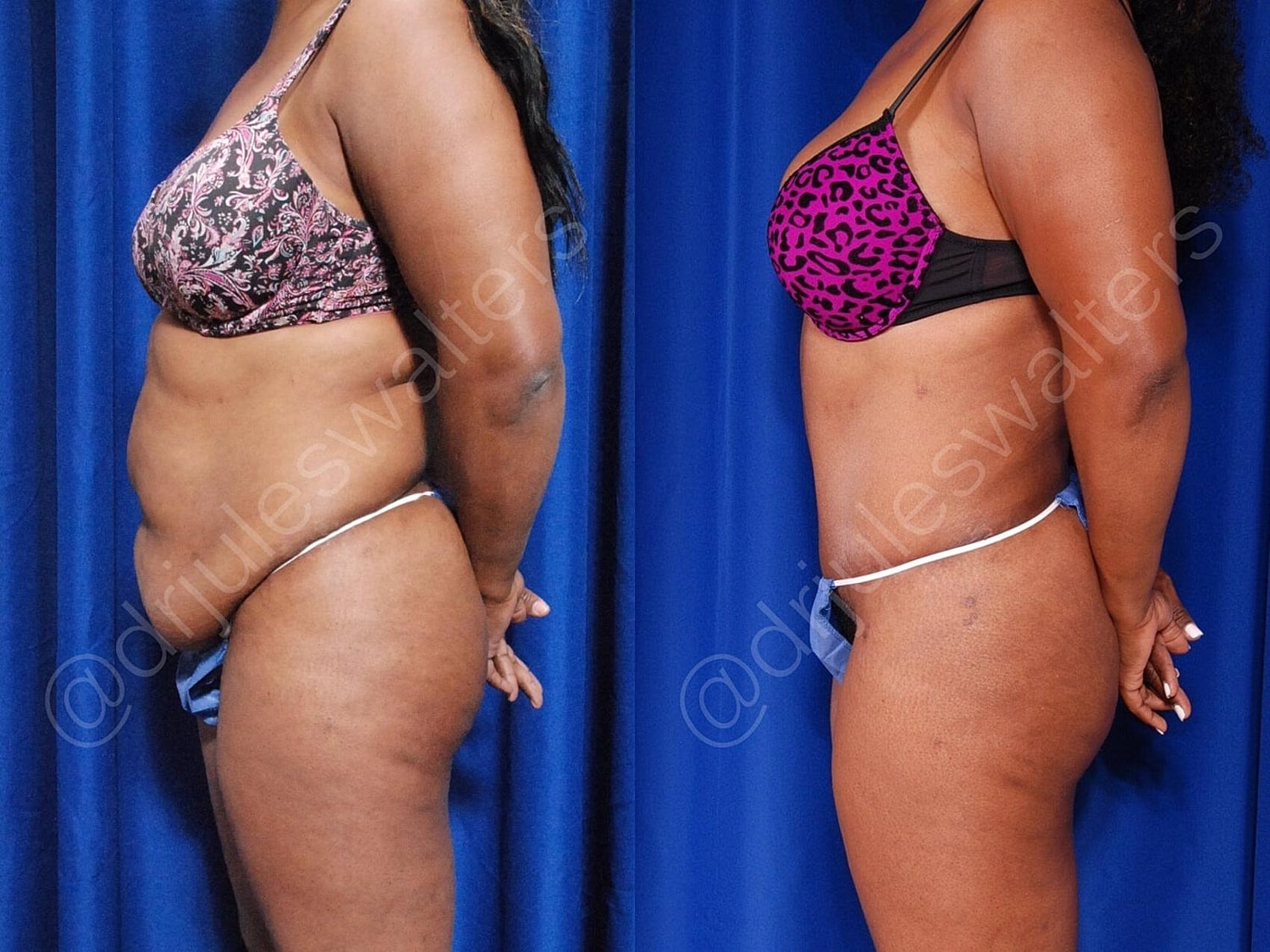 Tummy Tuck Before & After
