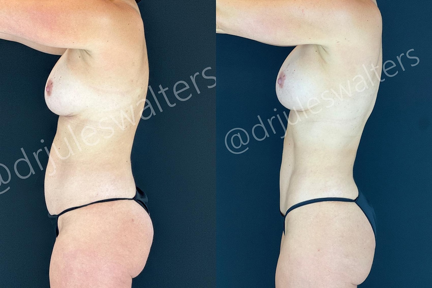 Tummy Tuck Before & After