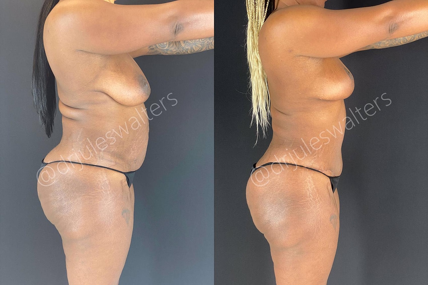 Tummy Tuck Before & After