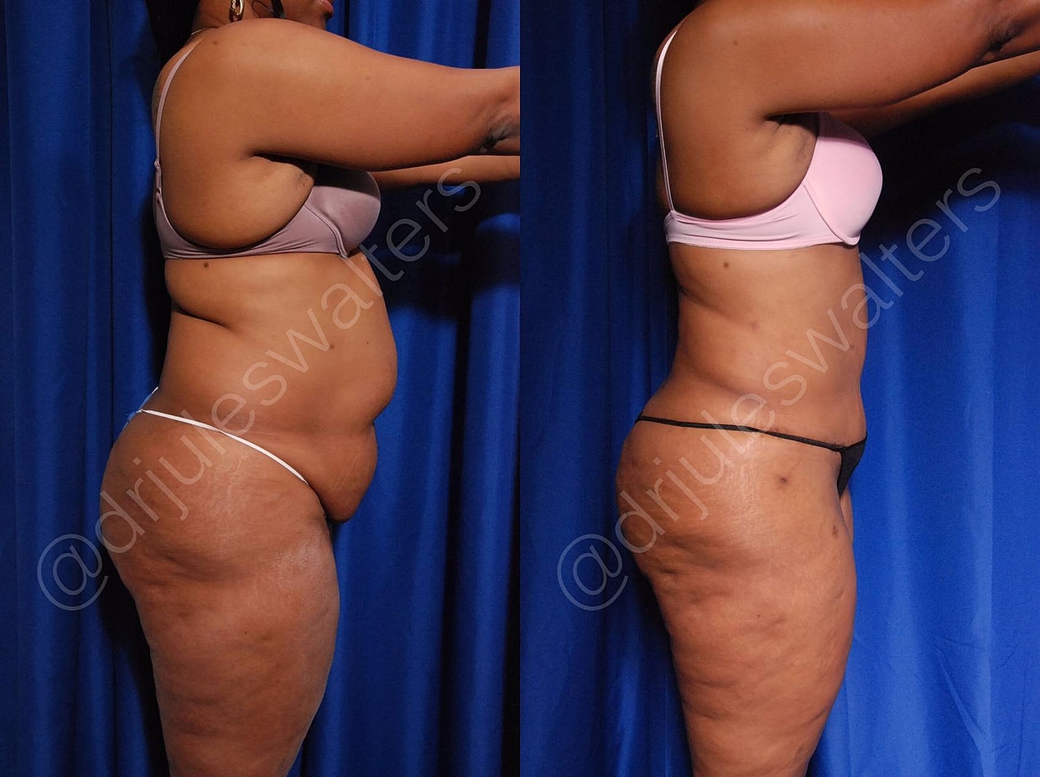 Tummy Tuck Before & After