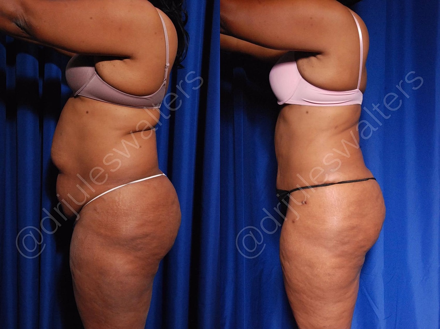 Tummy Tuck Before & After