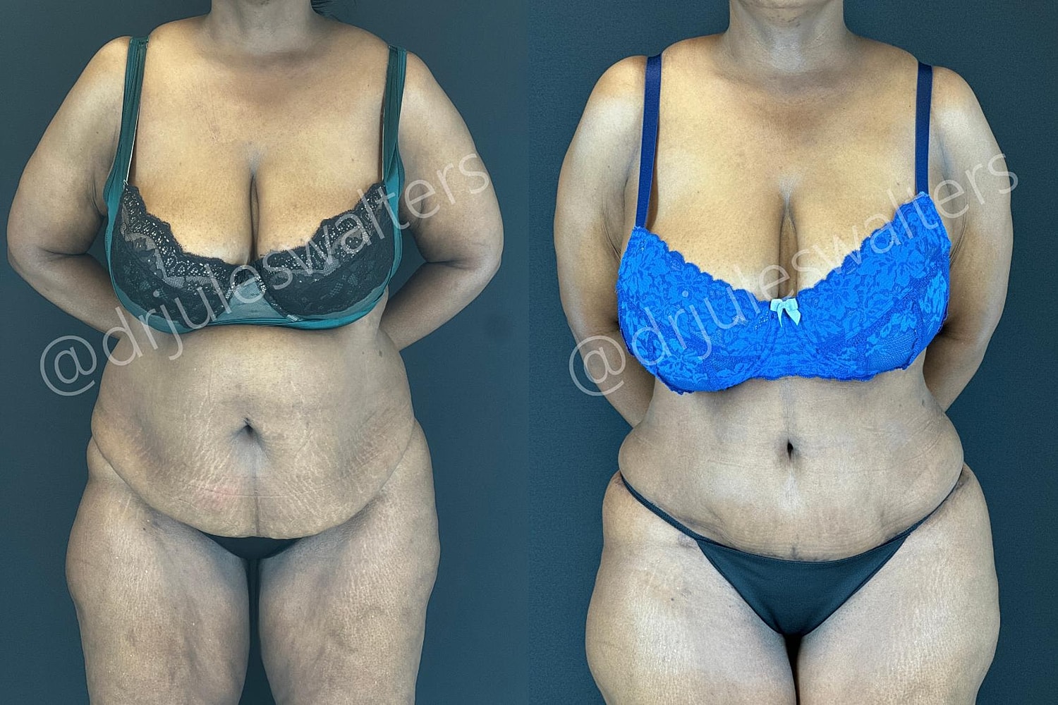 Tummy Tuck Before & After