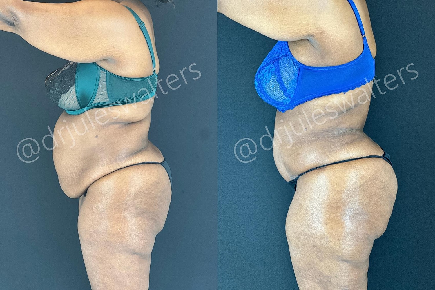 Tummy Tuck Before & After