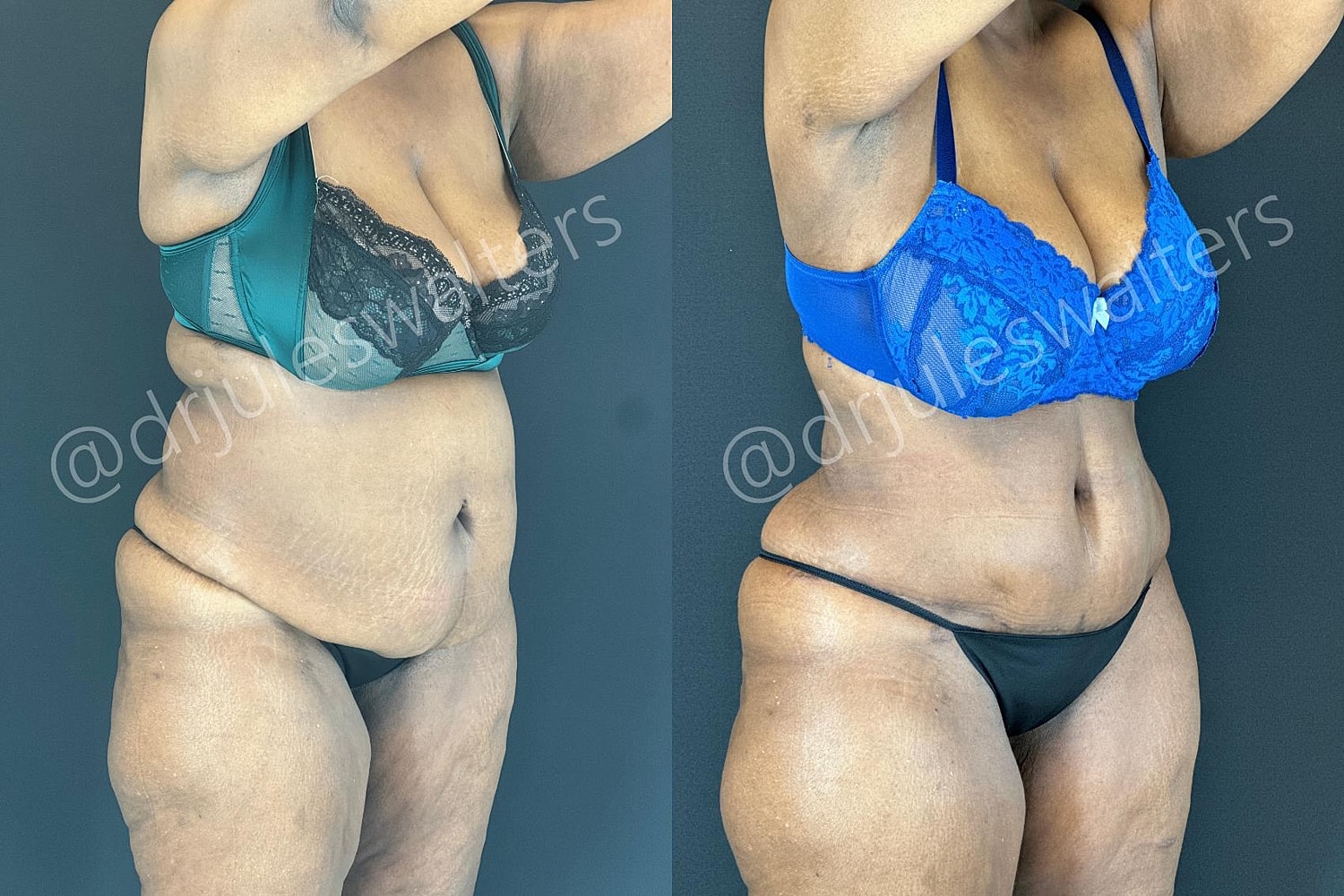 Tummy Tuck Before & After