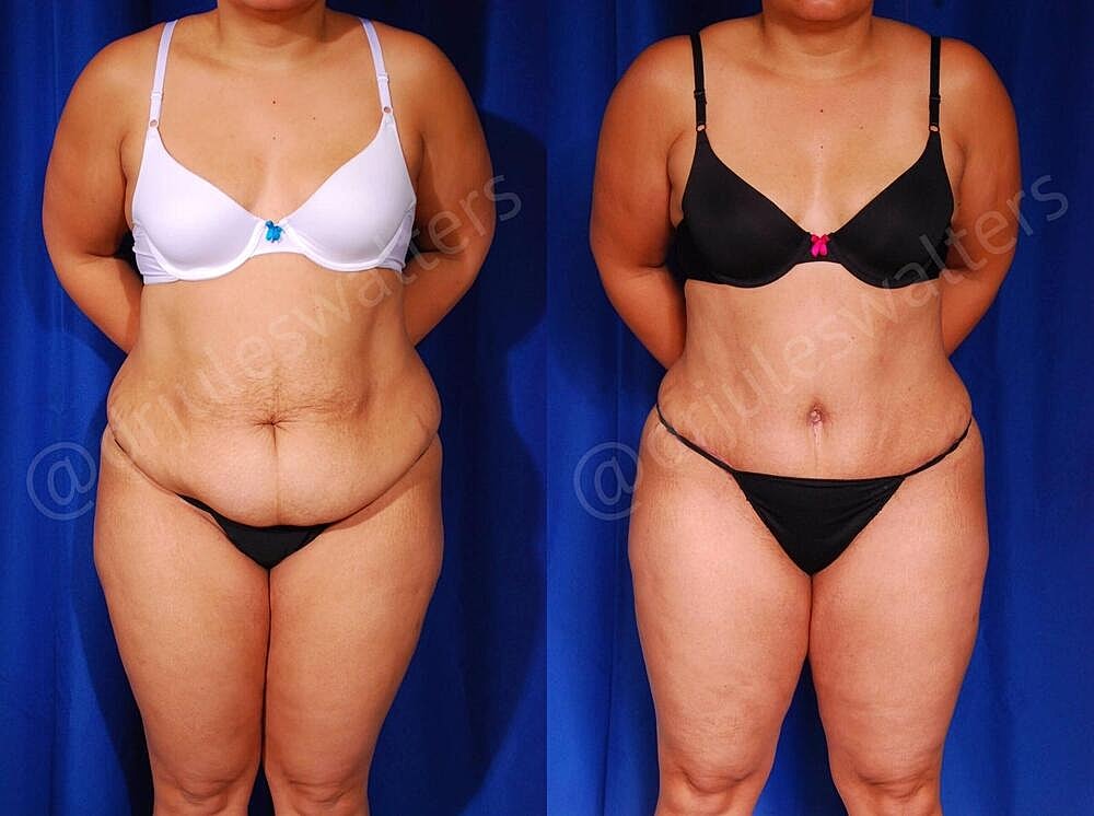 Tummy Tuck Before & After