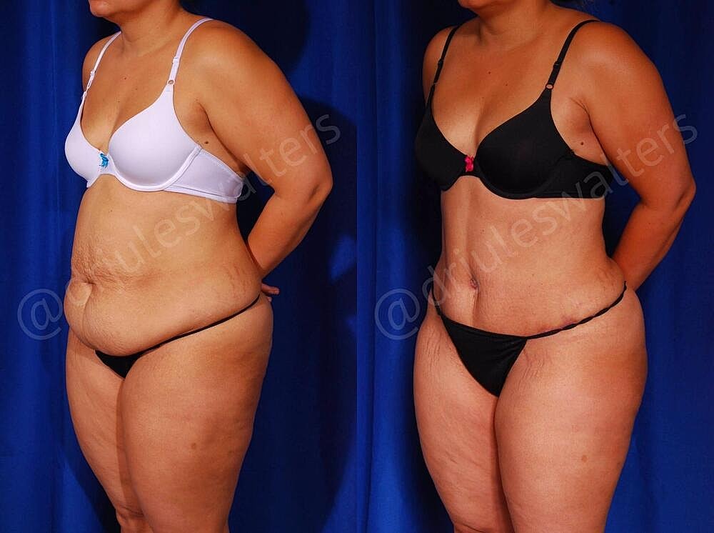 Tummy Tuck Before & After