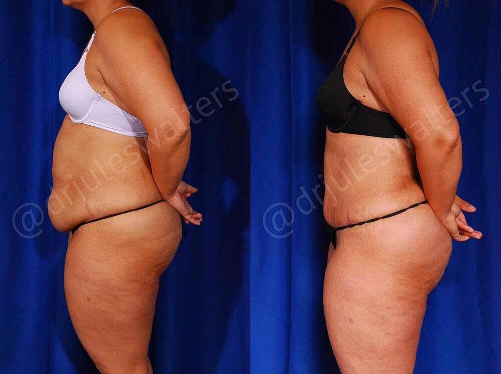 Tummy Tuck Before & After