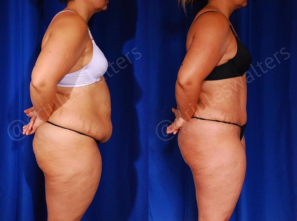 Tummy Tuck Before & After