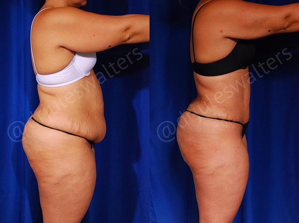 Tummy Tuck Before & After