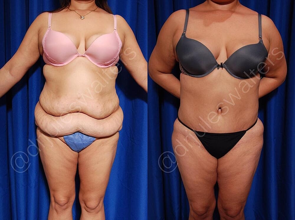 Tummy Tuck Before & After