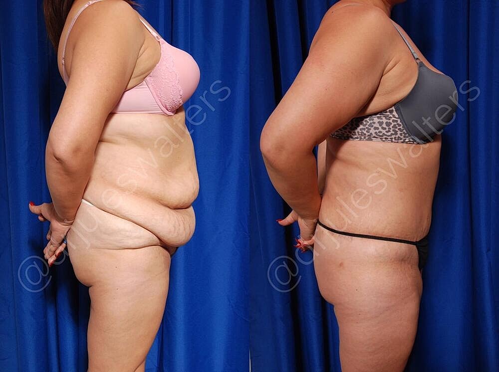 Tummy Tuck Before & After