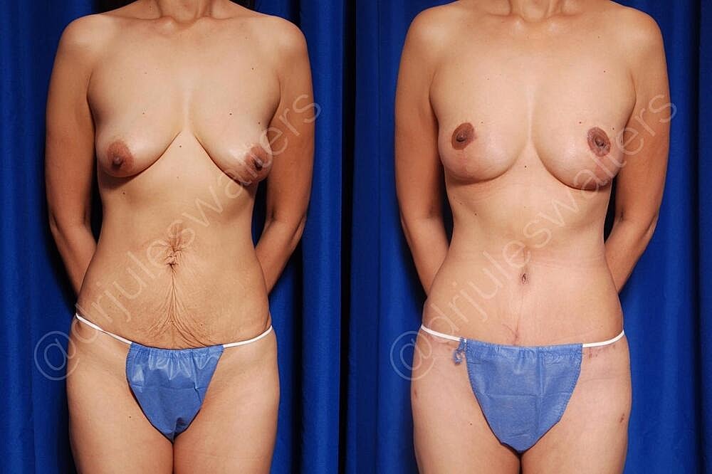 Tummy Tuck Before & After