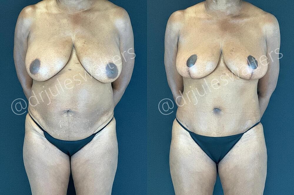 Tummy Tuck Before & After