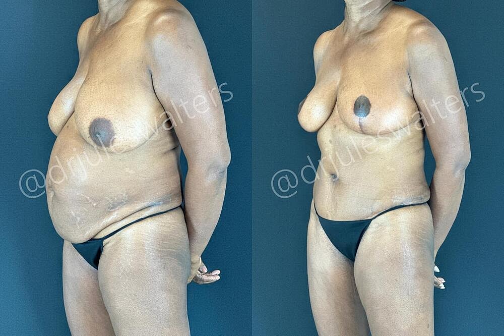Tummy Tuck Before & After
