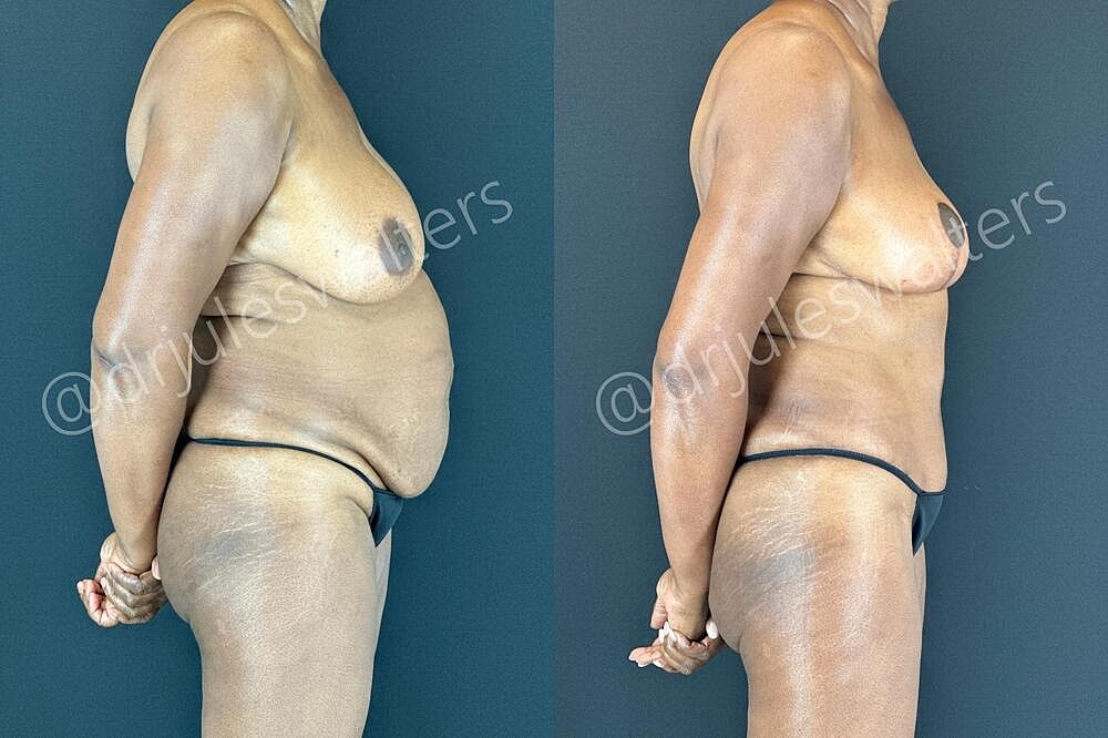 Tummy Tuck Before & After