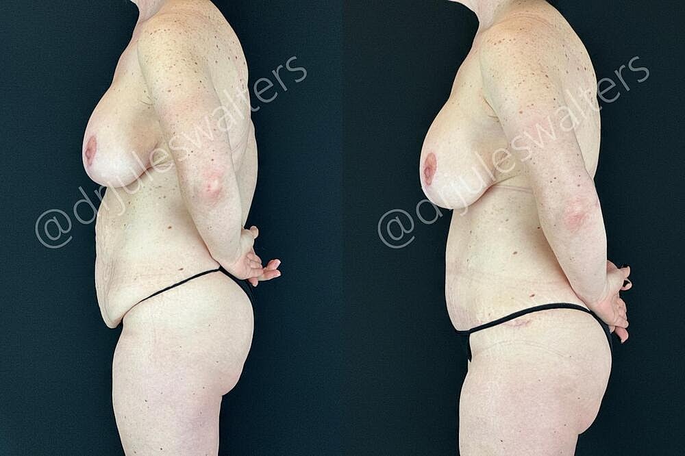 Tummy Tuck Before & After