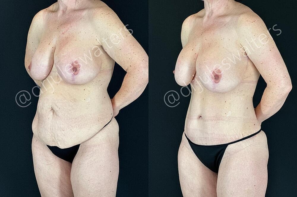 Tummy Tuck Before & After