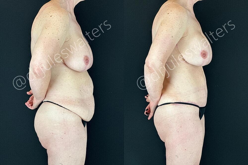 Tummy Tuck Before & After