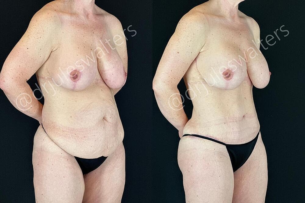 Tummy Tuck Before & After
