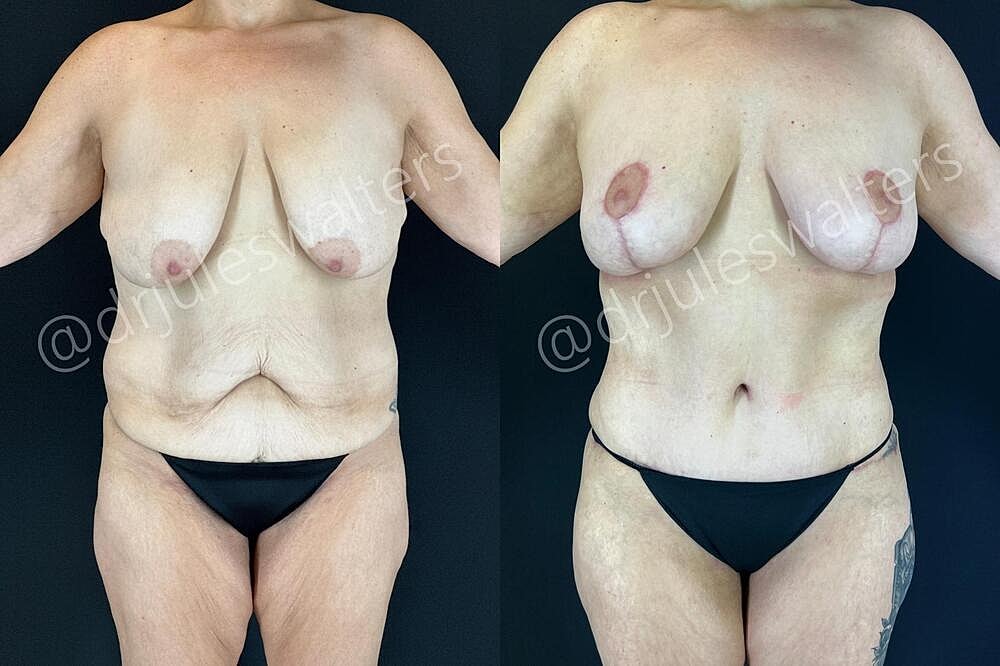 Tummy Tuck Before & After