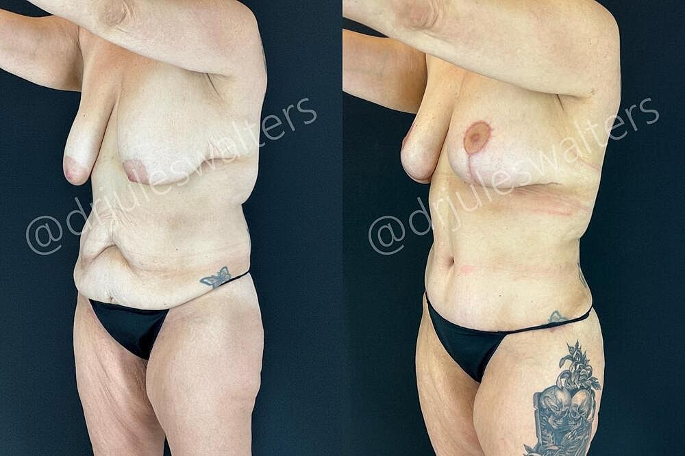 Tummy Tuck Before & After
