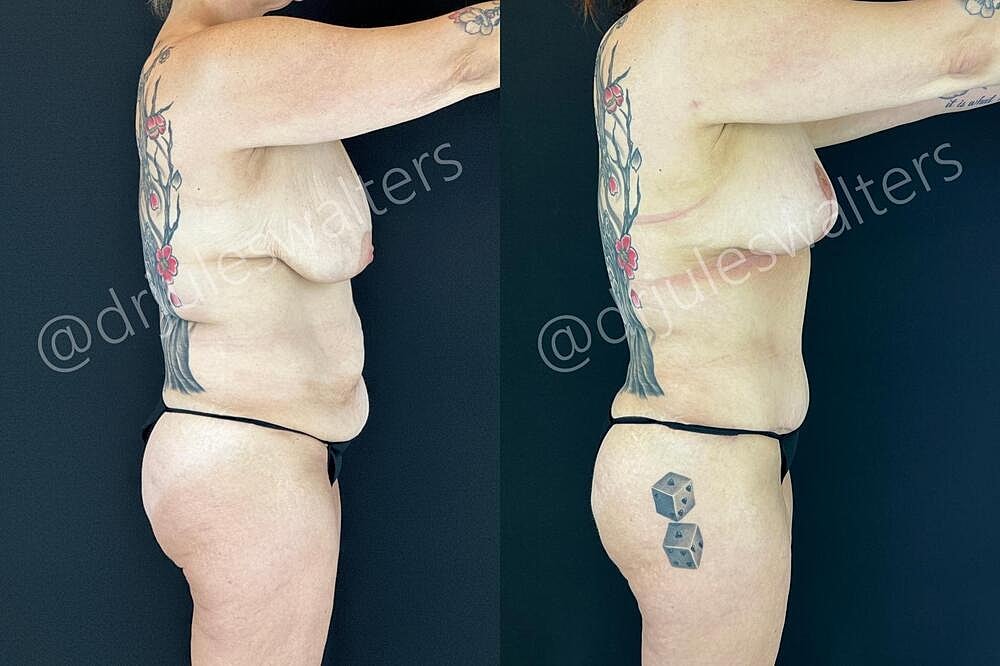 Tummy Tuck Before & After