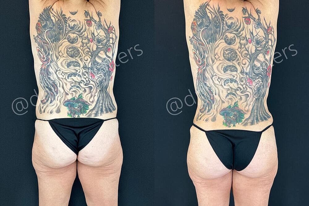 Tummy Tuck Before & After