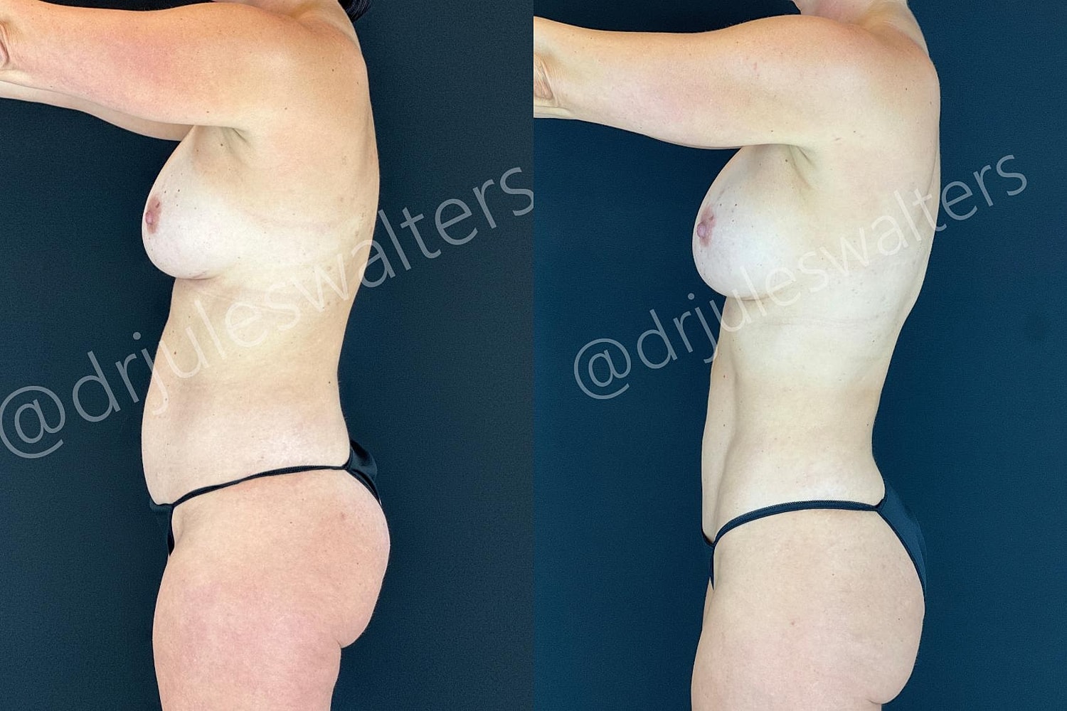Hidefinition Liposuction Before & After
