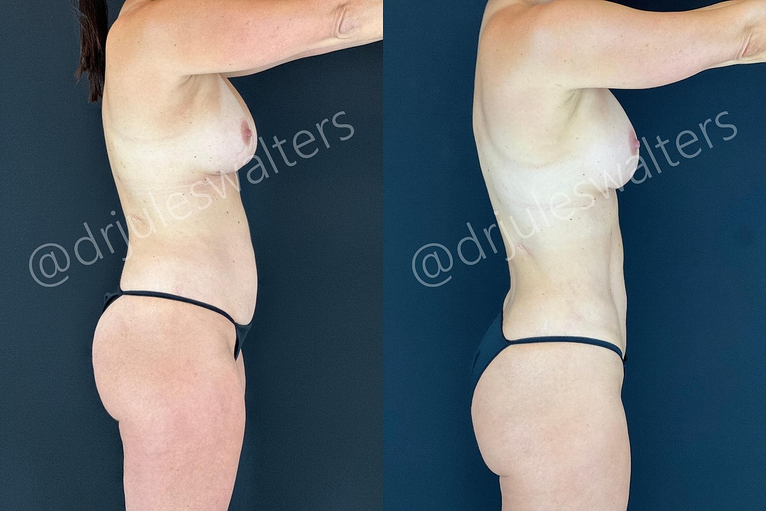 Hidefinition Liposuction Before & After