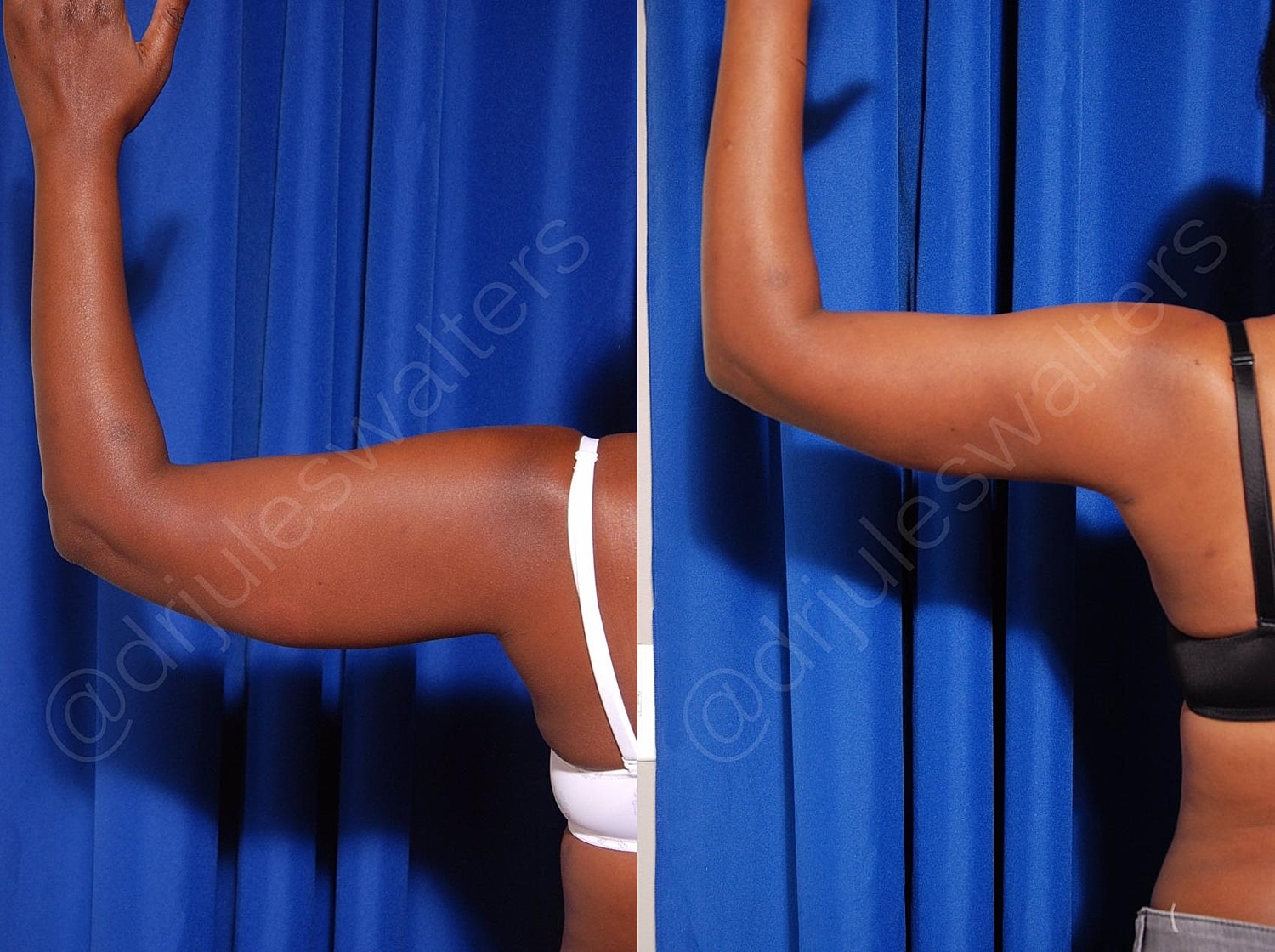 Hidefinition Liposuction Before & After