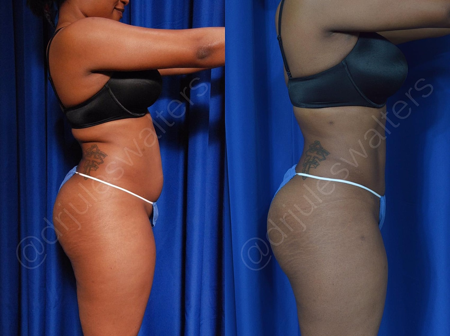Hidefinition Liposuction Before & After