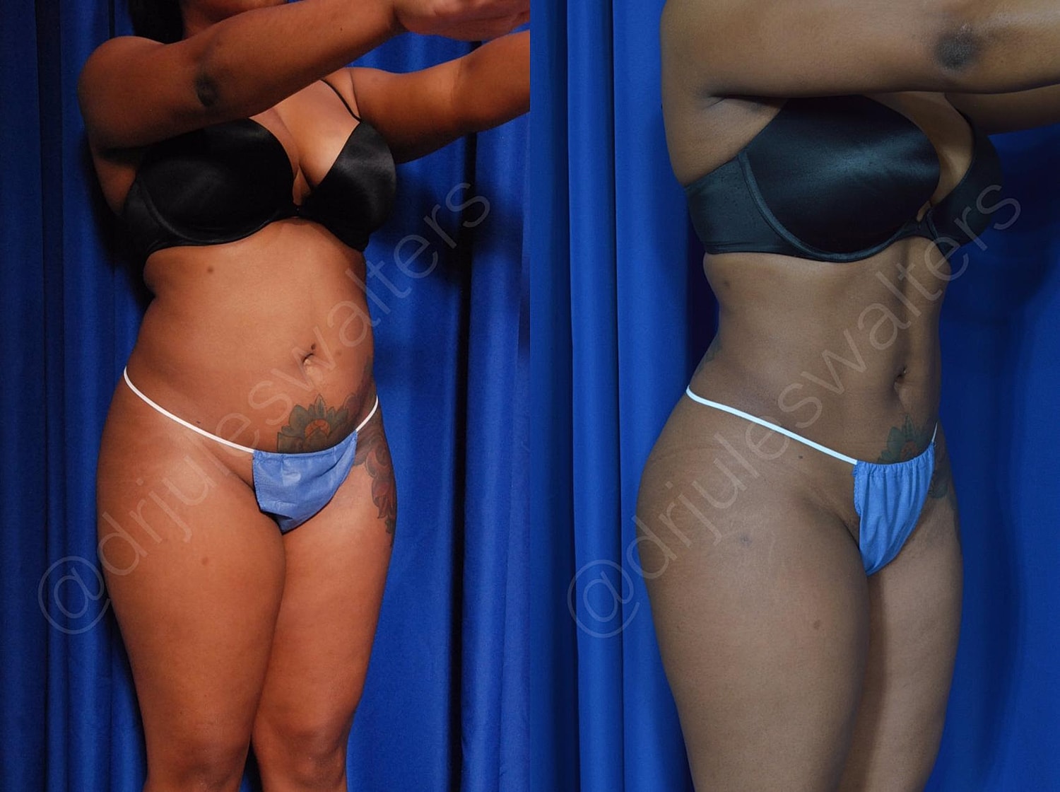 Hidefinition Liposuction Before & After