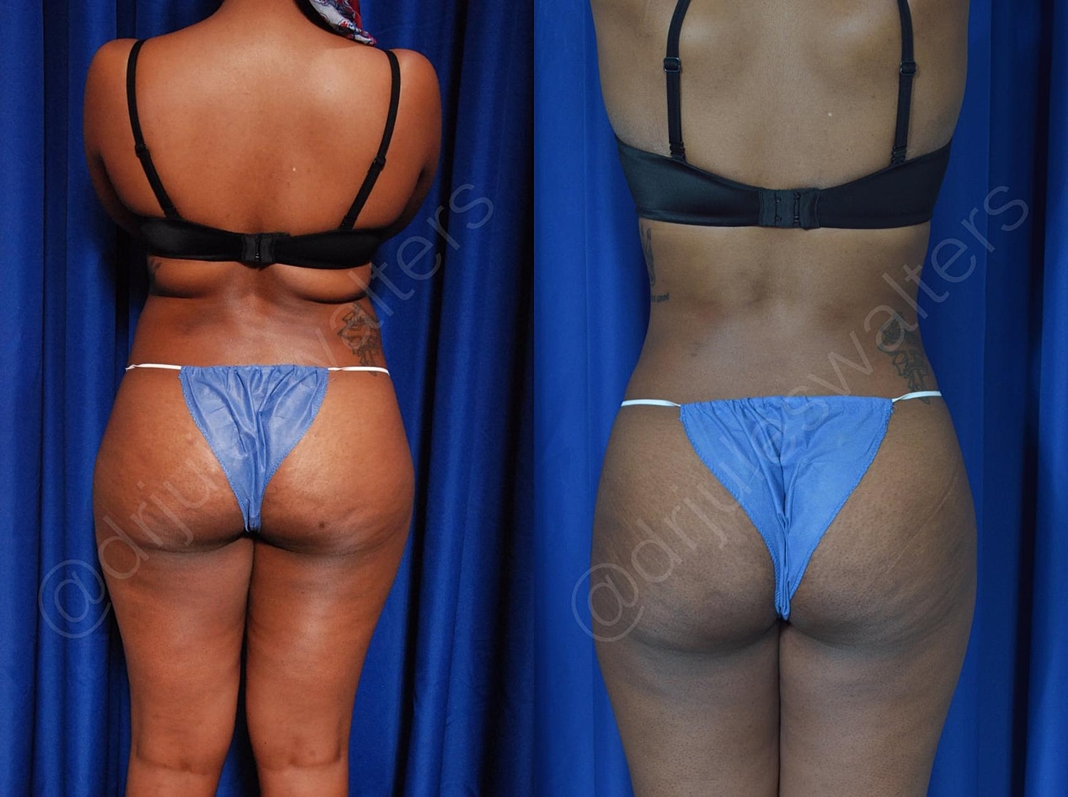Hidefinition Liposuction Before & After