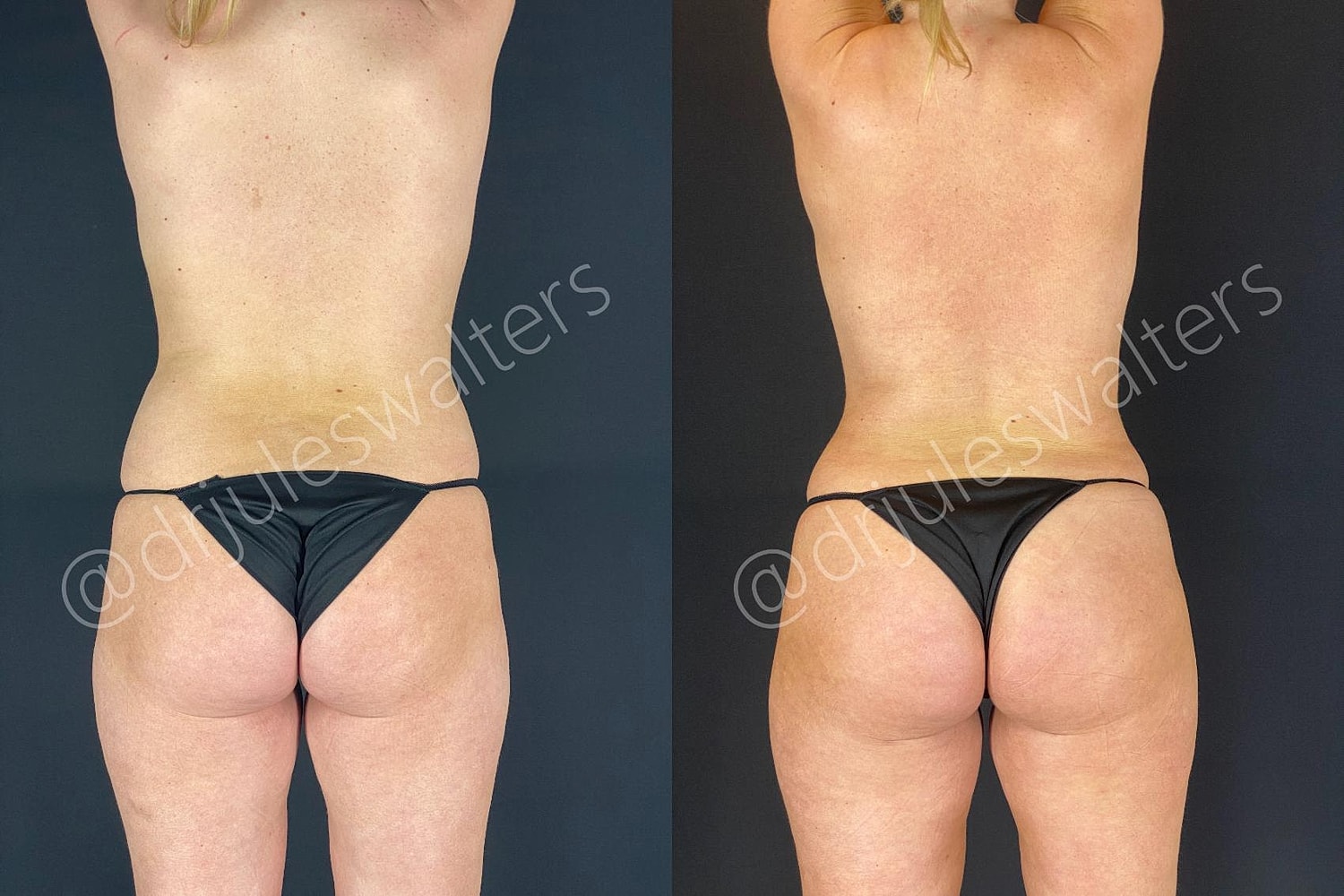 Hidefinition Liposuction Before & After