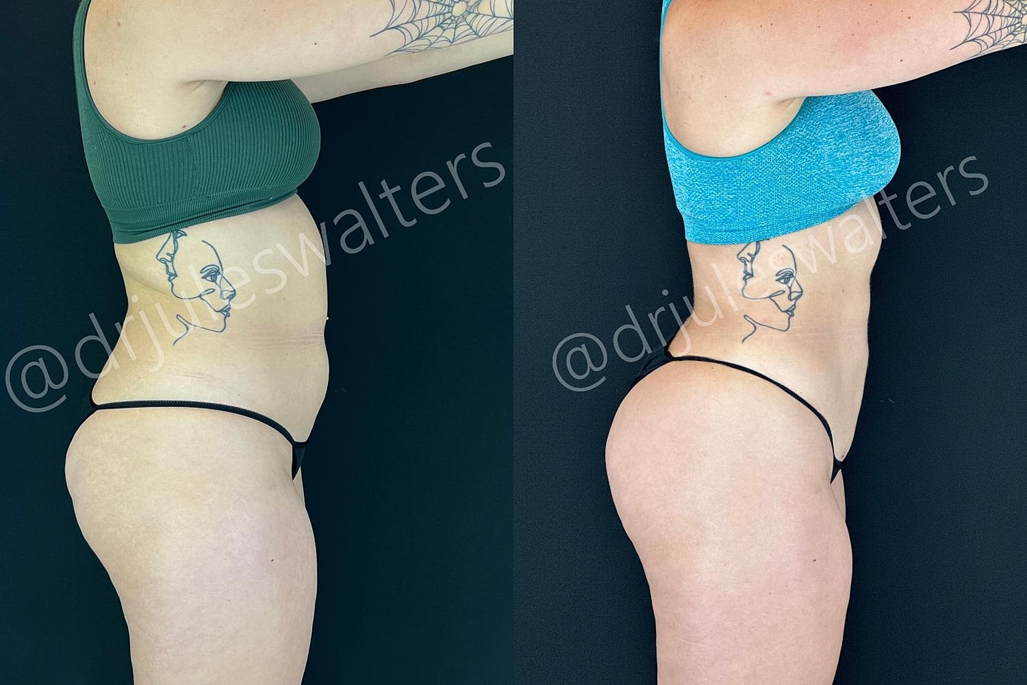 Hidefinition Liposuction Before & After