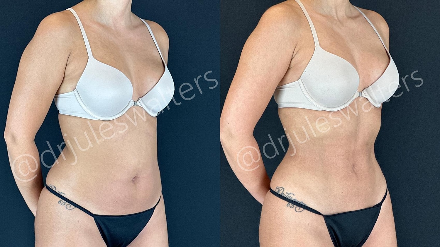 Hidefinition Liposuction Before & After