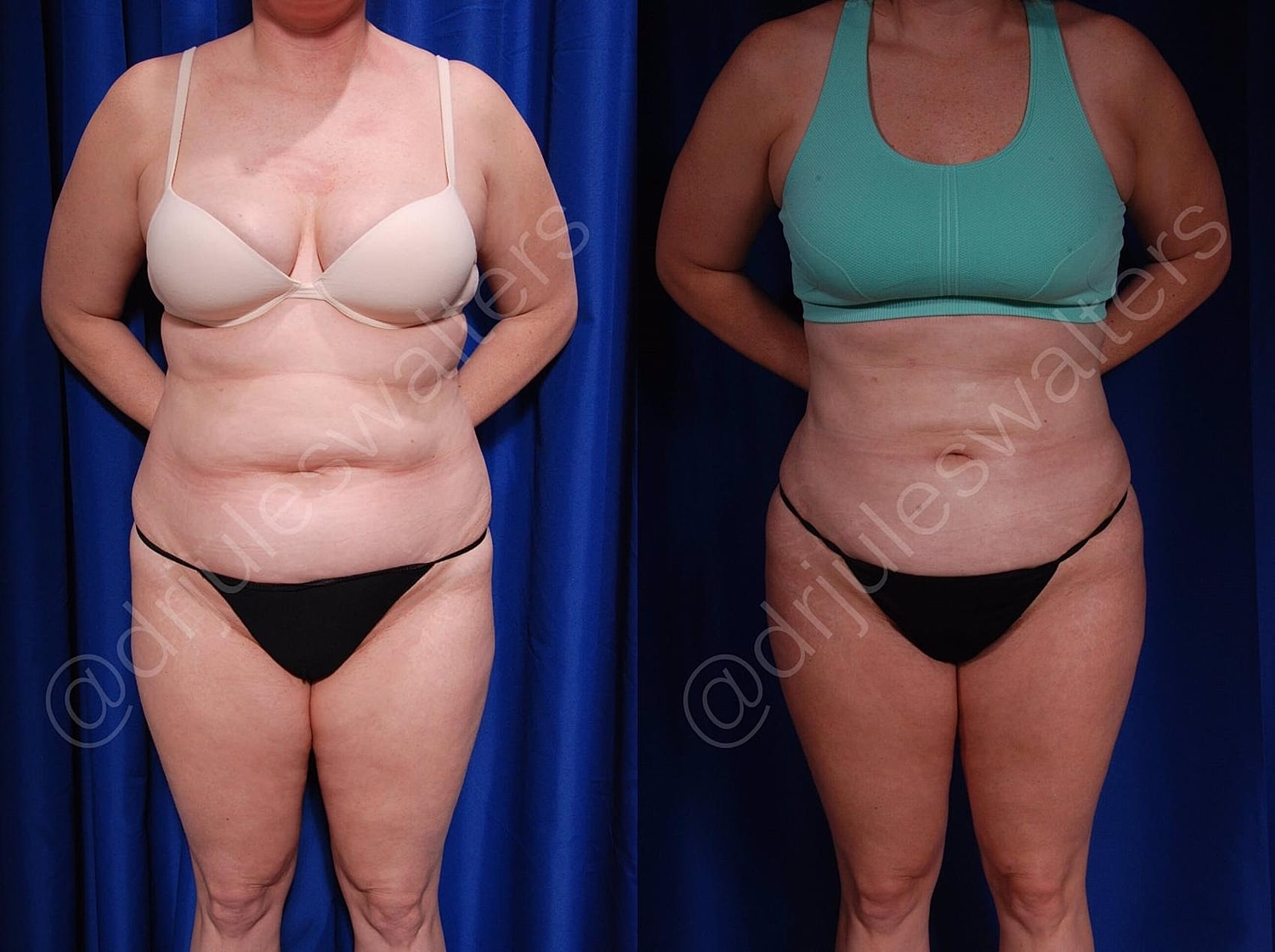 Body Contouring Before & After