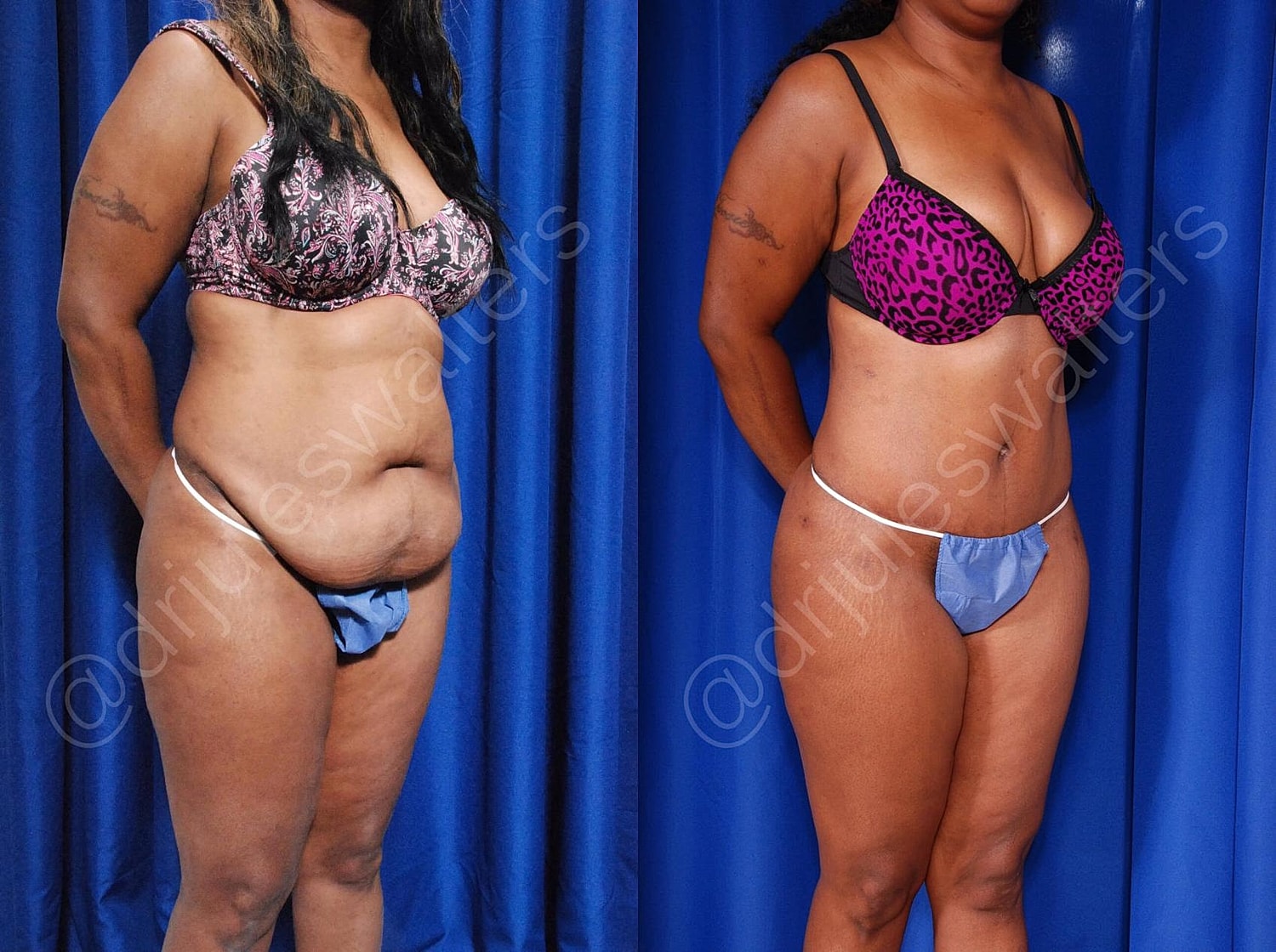 Body Contouring Before & After