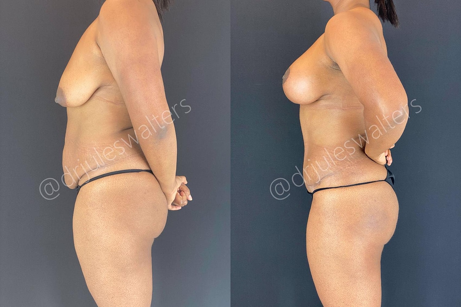 Body Contouring Before & After