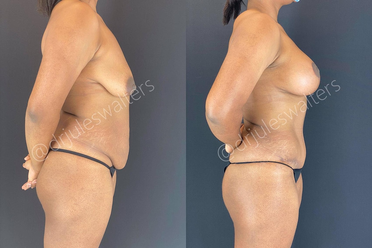 Body Contouring Before & After