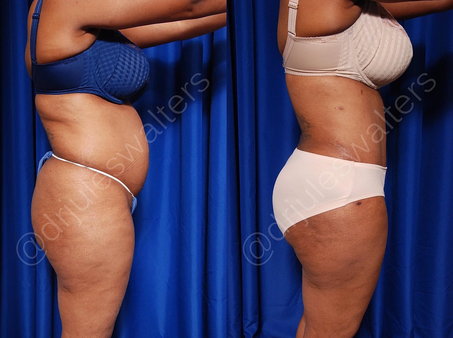 Body Contouring Before & After