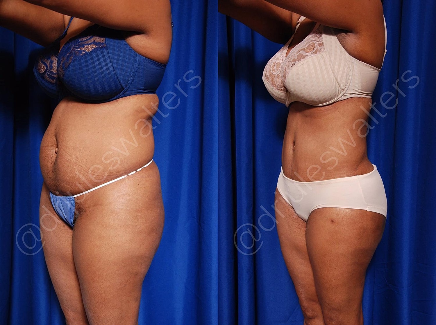 Body Contouring Before & After