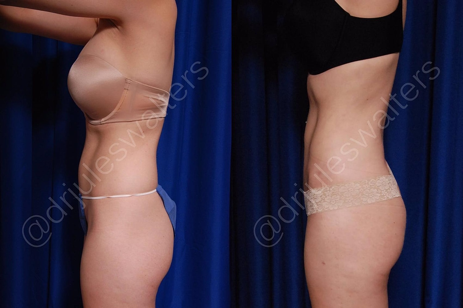 Body Contouring Before & After