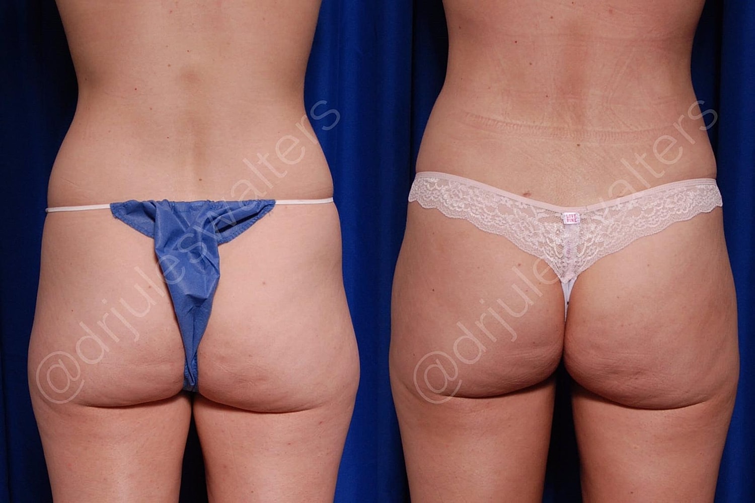 Body Contouring Before & After